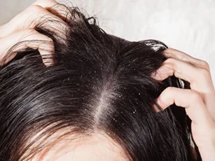 4 công thức sạch gàu với chanh không mất tiền