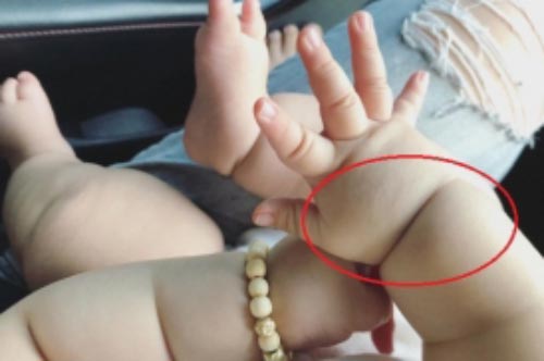 Con có ngấn tay chân chưa chắc là do bụ bẫm: Có thể bé đang mắc phải hội chứng nguy hiểm hiếm gặp
