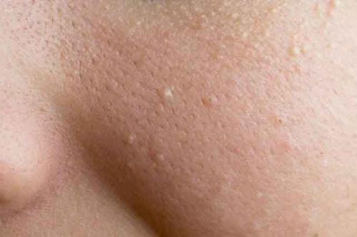 Mụn đầu trắng và những điều bạn cần biết