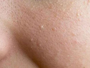 Mụn đầu trắng và những điều bạn cần biết
