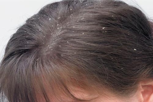 Trị gàu tận gốc tại nhà có thể bạn chưa biết