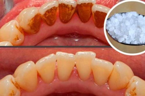 Dù cao răng lâu năm, dày bám chắc cỡ nào cũng bật ra từng mảng chưa hết 1 ngàn