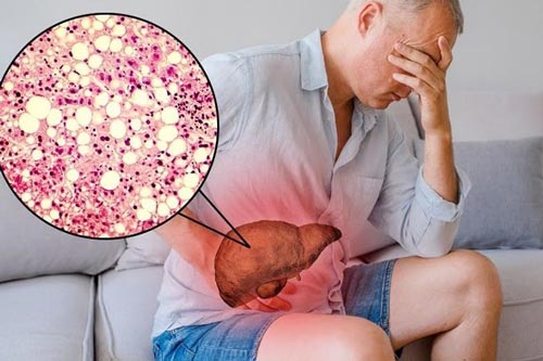 Cách để hạ men gan mà không cần thuốc