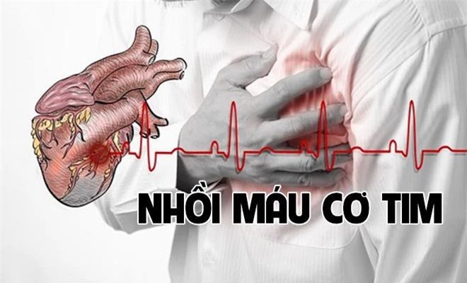 Dấu hiệu nhận biết bệnh nhồi máu cơ tim