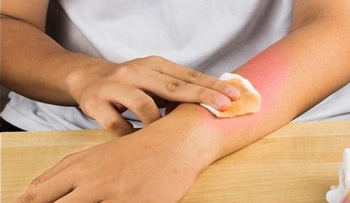 Cách chữa vết bỏng bạn phải ghi nhớ luôn hôm nay