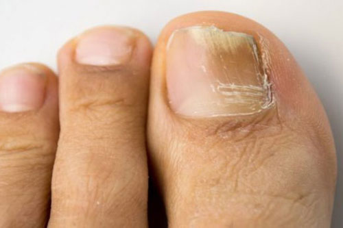 3 cách giúp bạn giải quyết tình trạng nấm móng