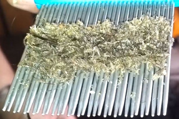 Choáng với cô bé "nuôi" hàng triệu con chấy trên đầu