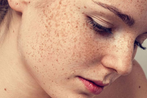 2 công thức trị tàn nhang rất đơn giản