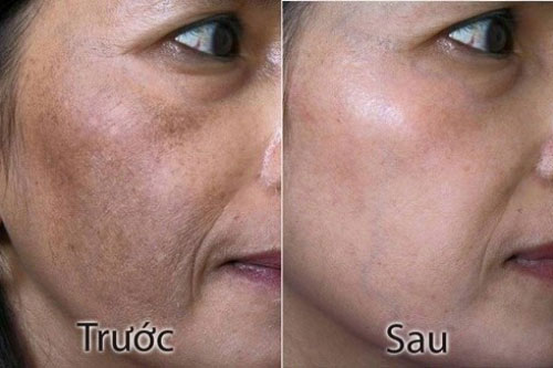 Dùng đá lạnh khoai tây nám da bao nhiêu cũng được lột sạch