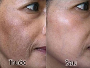 Dùng đá lạnh khoai tây nám da bao nhiêu cũng được lột sạch
