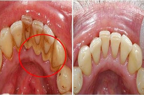 Cao răng dày tới mấy cũng bật ra từng mảng, hôi miệng kinh niên cũng có thể khỏi ngay lập tức