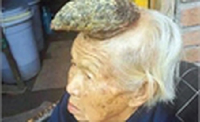 Chuyện lạ: Cụ bà mọc sừng dài trên đầu