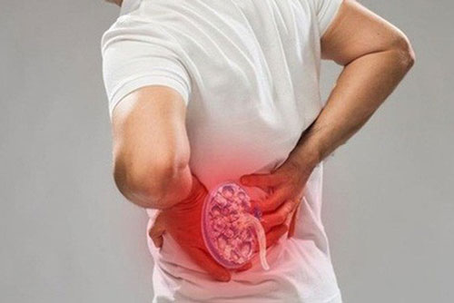 Nguyên nhân không ngờ khiến bạn bị bệnh sỏi thận