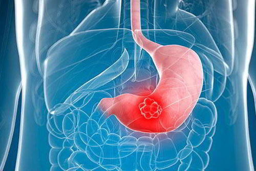 Dấu hiệu cảnh báo bệnh ung thư dạ dày