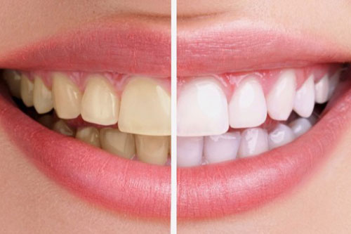 3 công thức tẩy trắng răng tại nhà đơn giản có thể bạn chưa biết