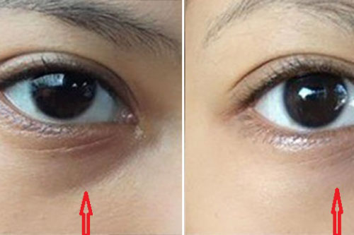3 cách chữa thâm mắt vô cùng đơn giản