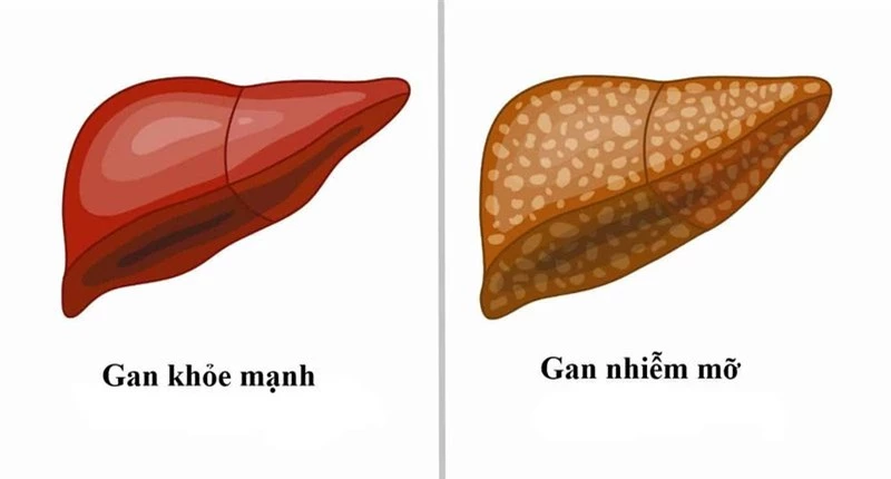 gan nhiễm mỡ 