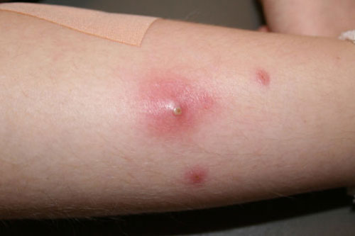 Cách chữa mụn nhọt tại nhà cực đơn giản bạn cần ghi nhớ