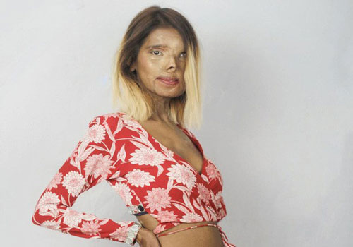 Nghị lực phi thường của nữ người mẫu, diễn viên bị cha ruột tạt axit khi mới 2 tháng tuổi