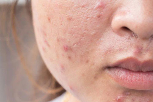 Ngộ nhận sai lầm về mụn trứng cá