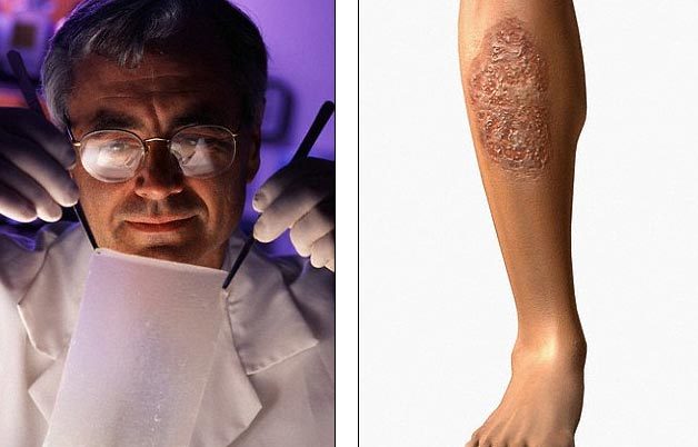 Chữa vết thương hiệu quả hơn bằng da... người chết