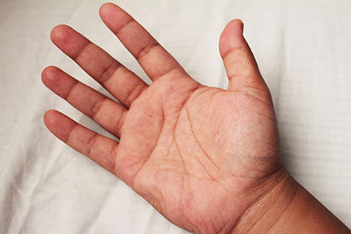 4 dấu hiệu ở lòng bàn tay cảnh báo bệnh nguy hiểm
