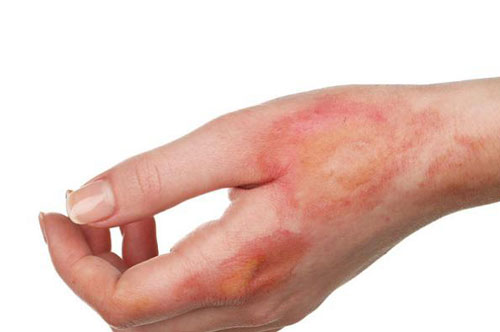 Những cách trị vết bỏng để không bị sẹo