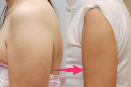 Cách giảm mỡ bắp tay cực dễ ai cũng có thể thực hiện