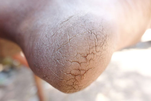 Dấu hiệu ở chân cảnh báo bạn đang bị bệnh