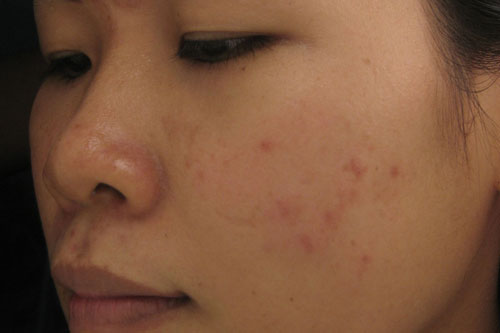 Thâm mụn nặng đến mấy cũng chữa được chỉ bằng cách dùng nghệ