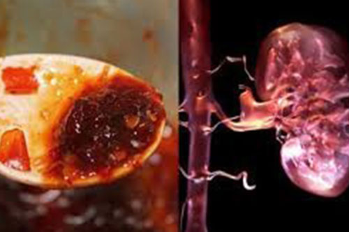 9 thực phẩm khiến thận 'nát bấy', càng ăn nhiều càng nhanh đi chạy thận