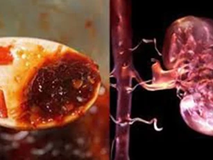 9 thực phẩm khiến thận 'nát bấy', càng ăn nhiều càng nhanh đi chạy thận