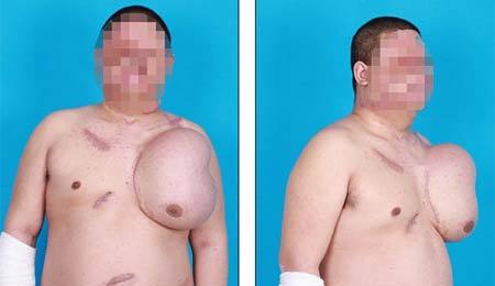 Chuyện lạ: Chàng trai "mọc" đầu ở ngực