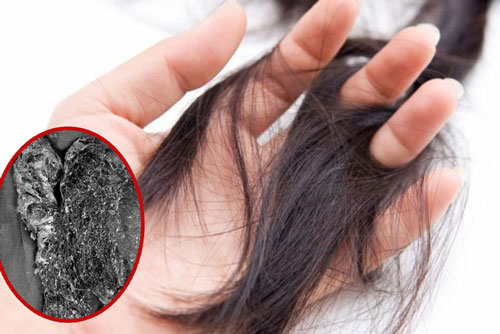 Bé gái tắc ruột vì thói quen ăn tóc, búi tóc khiến nhiều người hãi hùng