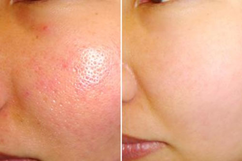 Lỗ chân lông to như sẹo rỗ cũng khỏi chỉ trong vài ngày