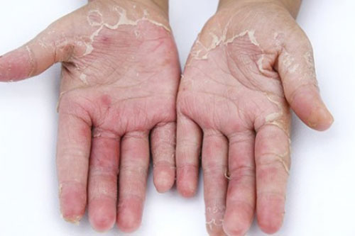 Dấu hiệu cảnh báo cơ thể đang thiếu vitamin C