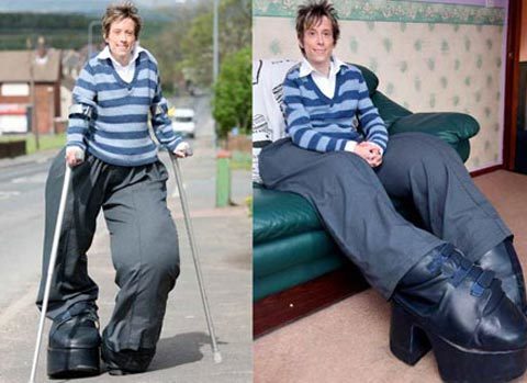 Người phụ nữ sở hữu đôi "chân voi"