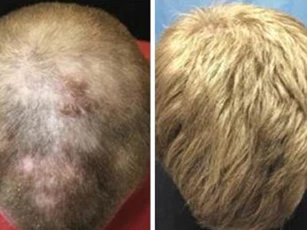 Trị hói bằng thuốc chữa... viêm khớp