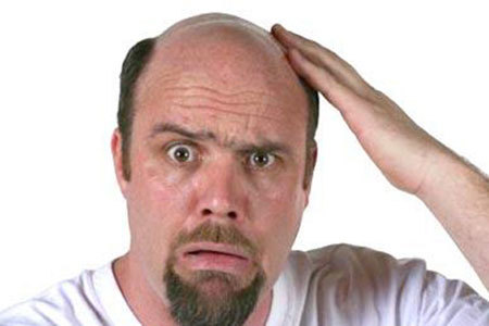 Hói ở nam giới ám chỉ nguy cơ bệnh tim
