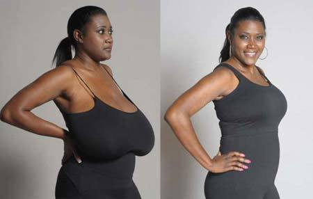 Người phụ nữ mắc chứng "ngực khủng"