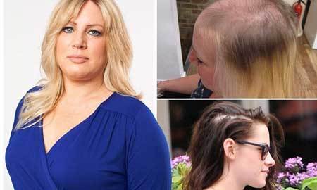 Thất tình có thể khiến phụ nữ hói đầu