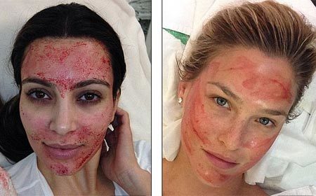 Liệu pháp chữa hói mới kiểu ma cà rồng