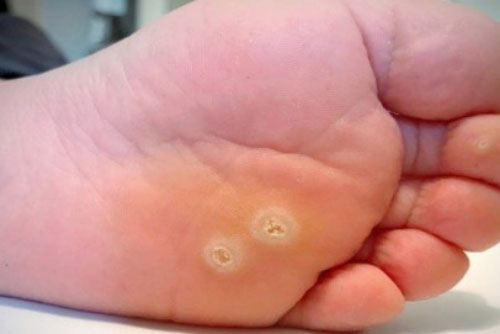 Dùng tỏi bạn có thể trị mụn cóc tại nhà