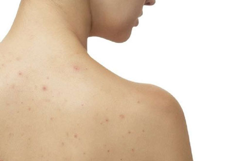 Mụn ở lưng trị thế nào cho đúng?