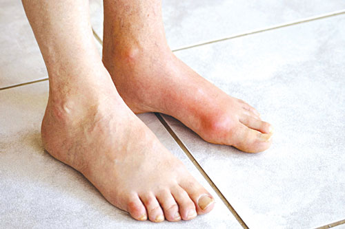 Người bị bệnh gout nên ăn thực phẩm nào?