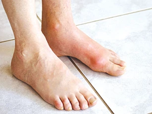 Người bị bệnh gout nên ăn thực phẩm nào?