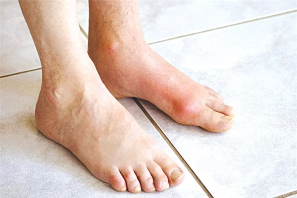 bệnh gout