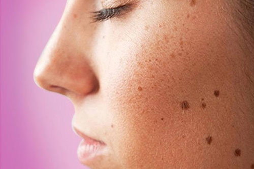 3 điều cần làm tốt để không bị đốm đồi mồi trên da