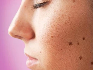 3 điều cần làm tốt để không bị đốm đồi mồi trên da