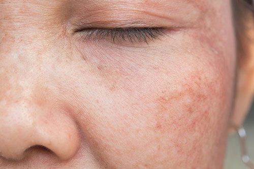 Tại sao bạn bị các đốm đồi mồi trên da khi còn trẻ tuổi?